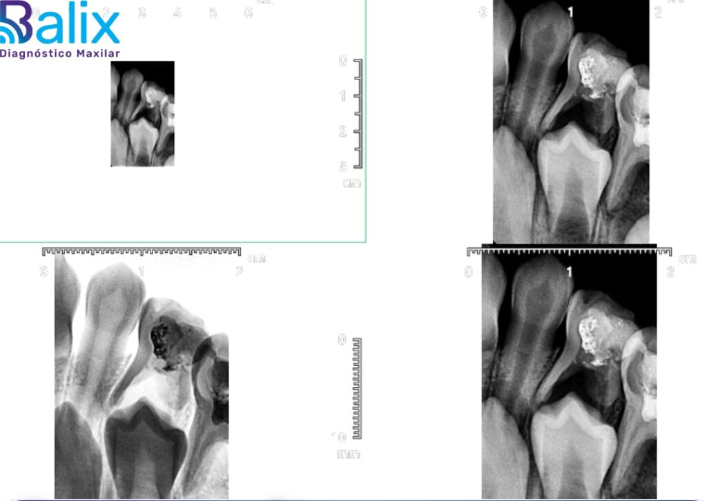 Periapical Individual