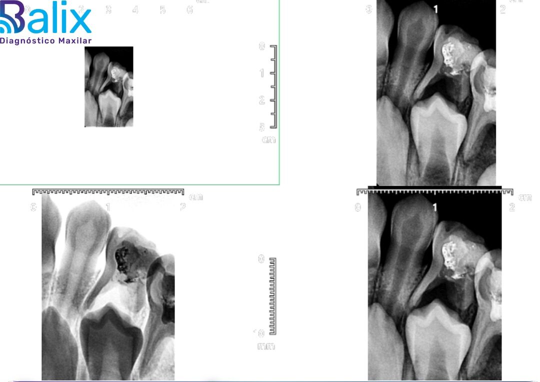 Periapical Individual